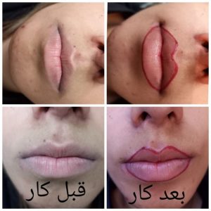 میکروبلیدینگ