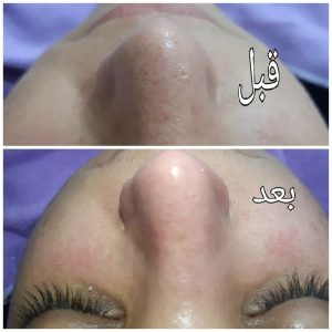 فشیال پاکسازی پوست