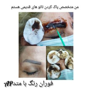 به چند مدل ریموو پاک کردن تاتو های قدیمی نیازمندیم