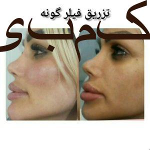 جشنواره تخفیف تزریق ژل و بوتاکس