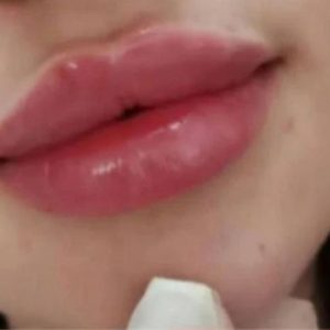 خدمات ژل وبوتاکس