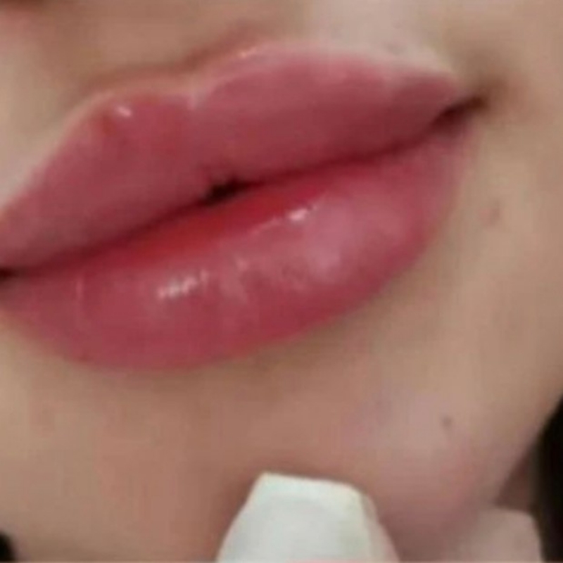 خدمات ژل وبوتاکس