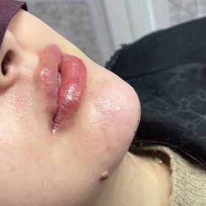 خدمات فیلر وبوتاکس