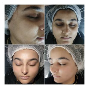 مدل میخام برای پاکسازی پوست هزینه مواد