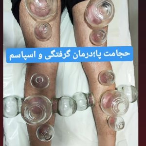 زالو درمانی و حجامت. ماساژ